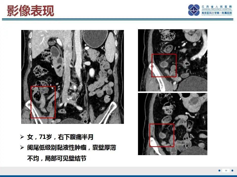 影像PPT - 【PPT】阑尾黏液性肿瘤-33