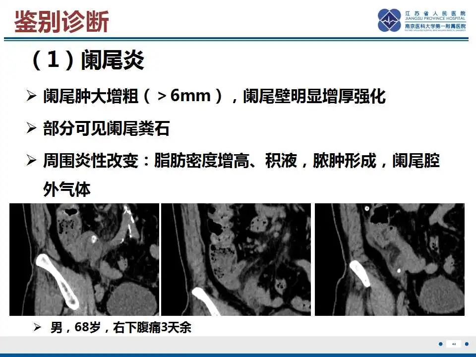 影像PPT - 【PPT】阑尾黏液性肿瘤-41