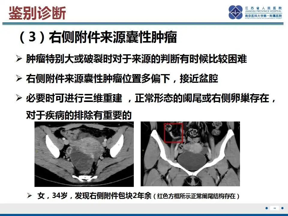 影像PPT - 【PPT】阑尾黏液性肿瘤-43