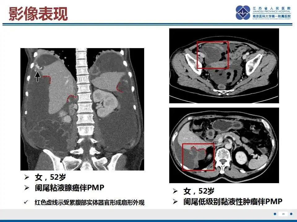 影像PPT - 【PPT】阑尾黏液性肿瘤-37