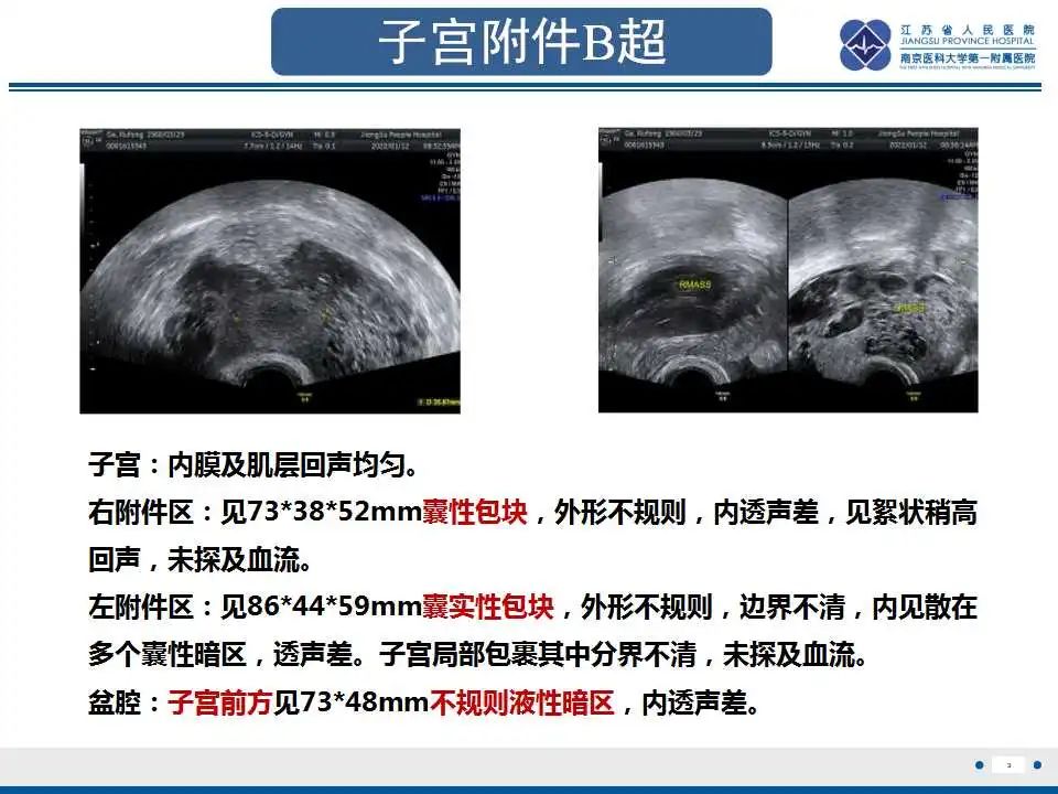 影像PPT - 【PPT】阑尾黏液性肿瘤-1