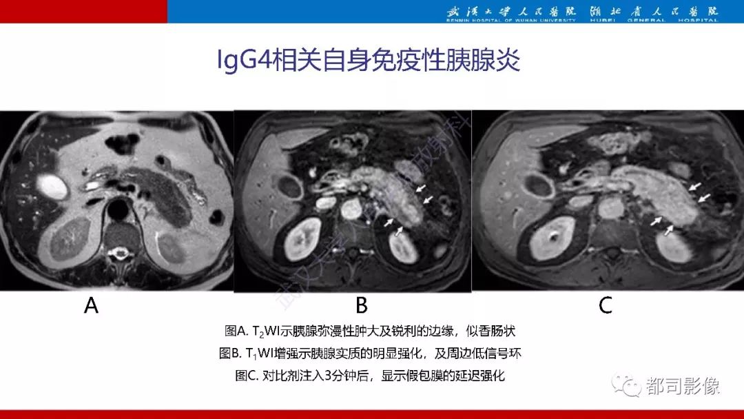 影像PPT - 【PPT】胰腺常见实质性肿瘤临床影像诊断与鉴别-8