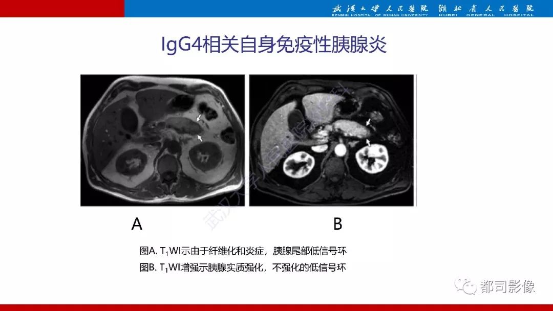 影像PPT - 【PPT】胰腺常见实质性肿瘤临床影像诊断与鉴别-9