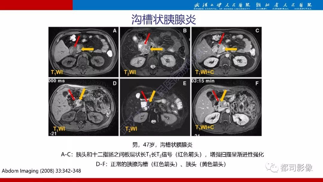 影像PPT - 【PPT】胰腺常见实质性肿瘤临床影像诊断与鉴别-4