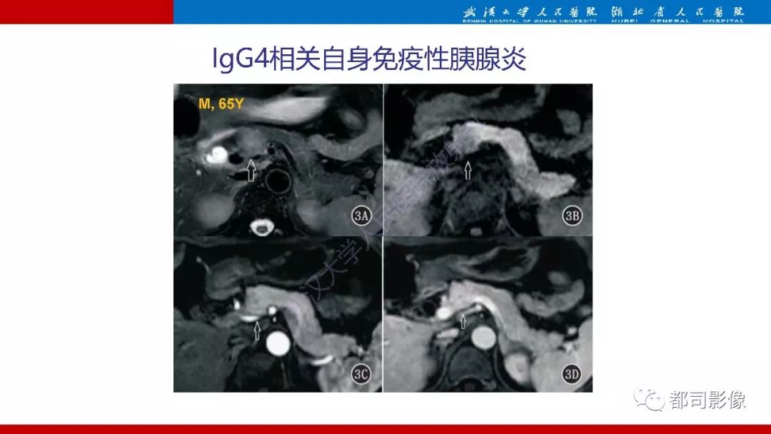 影像PPT - 【PPT】胰腺常见实质性肿瘤临床影像诊断与鉴别-13