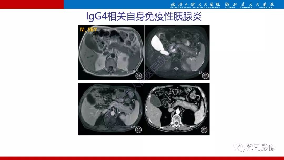 影像PPT - 【PPT】胰腺常见实质性肿瘤临床影像诊断与鉴别-10