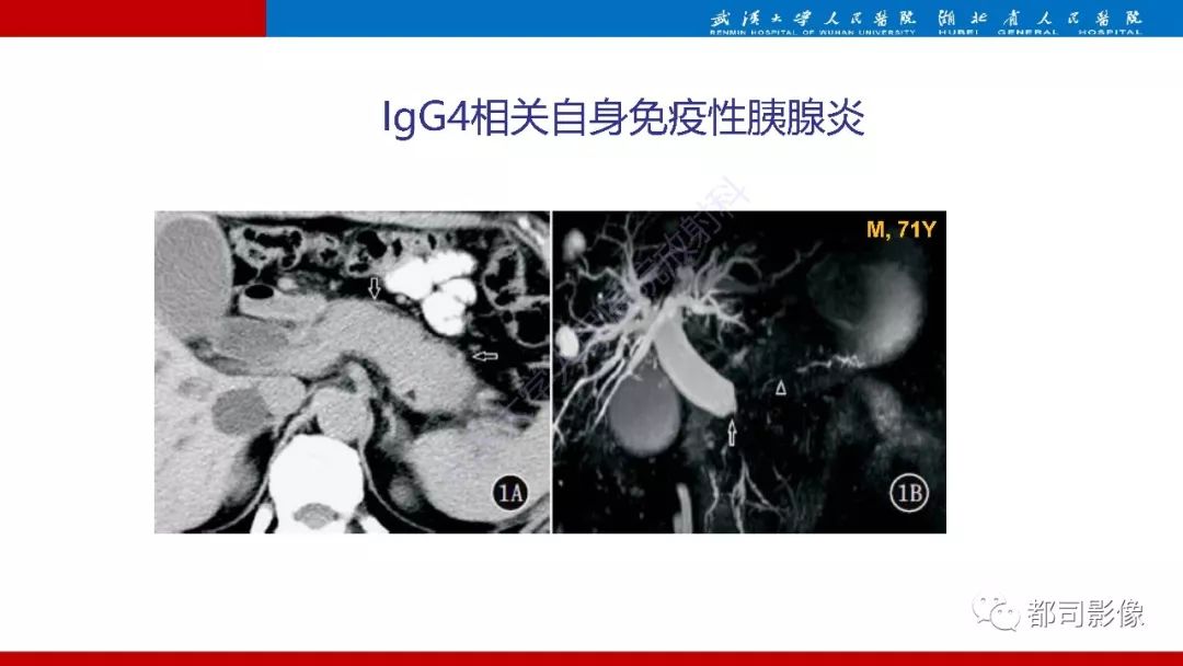 影像PPT - 【PPT】胰腺常见实质性肿瘤临床影像诊断与鉴别-11