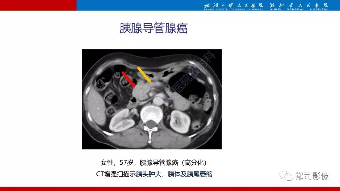 影像PPT - 【PPT】胰腺常见实质性肿瘤临床影像诊断与鉴别-16