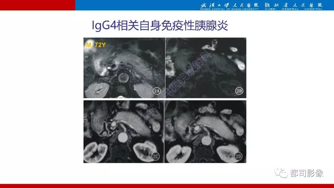 影像PPT - 【PPT】胰腺常见实质性肿瘤临床影像诊断与鉴别-12