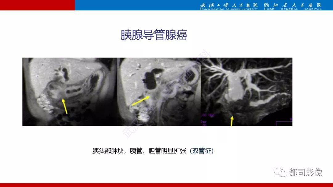 影像PPT - 【PPT】胰腺常见实质性肿瘤临床影像诊断与鉴别-17