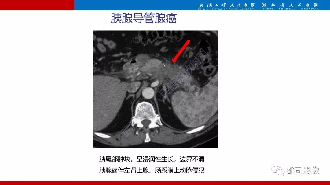 影像PPT - 【PPT】胰腺常见实质性肿瘤临床影像诊断与鉴别-18