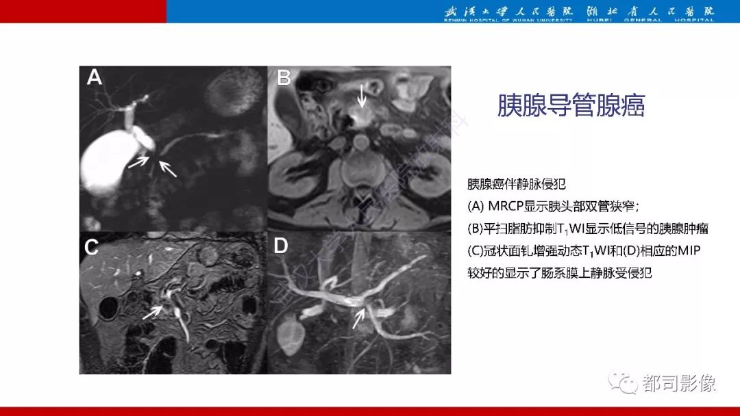 影像PPT - 【PPT】胰腺常见实质性肿瘤临床影像诊断与鉴别-19