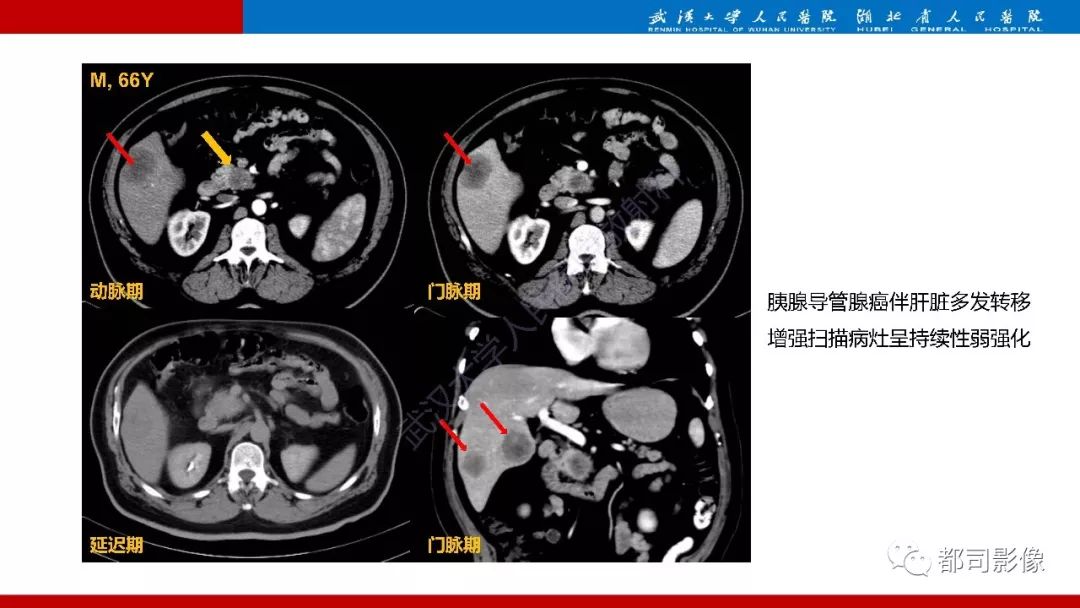 影像PPT - 【PPT】胰腺常见实质性肿瘤临床影像诊断与鉴别-20