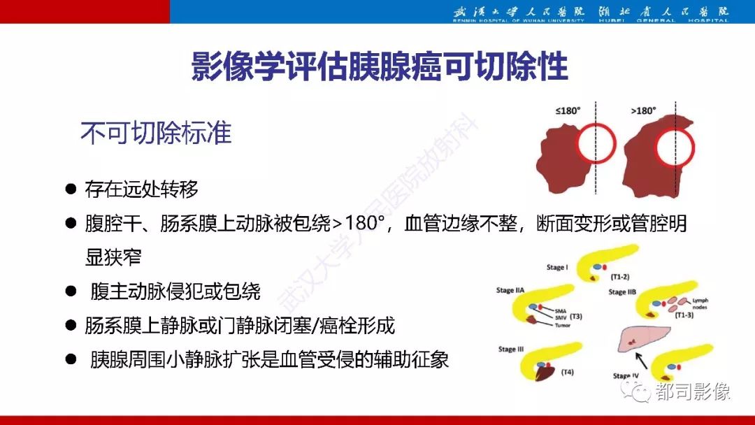 影像PPT - 【PPT】胰腺常见实质性肿瘤临床影像诊断与鉴别-22