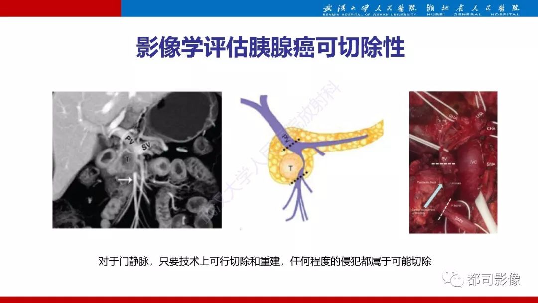 影像PPT - 【PPT】胰腺常见实质性肿瘤临床影像诊断与鉴别-23