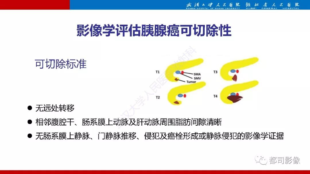 影像PPT - 【PPT】胰腺常见实质性肿瘤临床影像诊断与鉴别-21