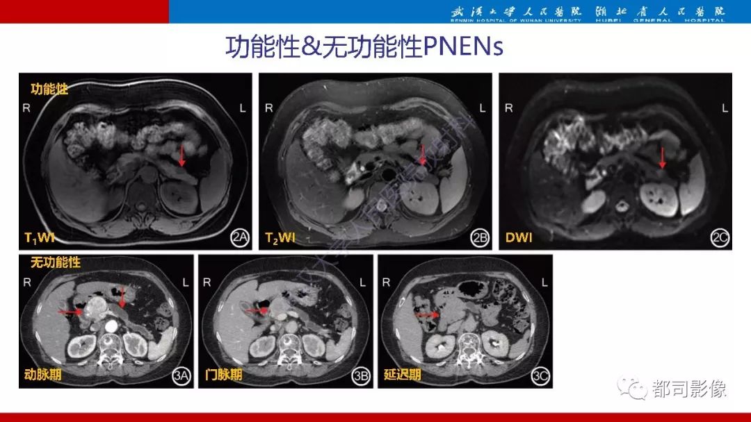 影像PPT - 【PPT】胰腺常见实质性肿瘤临床影像诊断与鉴别-26