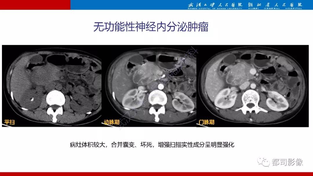 影像PPT - 【PPT】胰腺常见实质性肿瘤临床影像诊断与鉴别-28