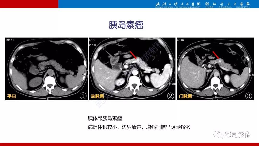 影像PPT - 【PPT】胰腺常见实质性肿瘤临床影像诊断与鉴别-27