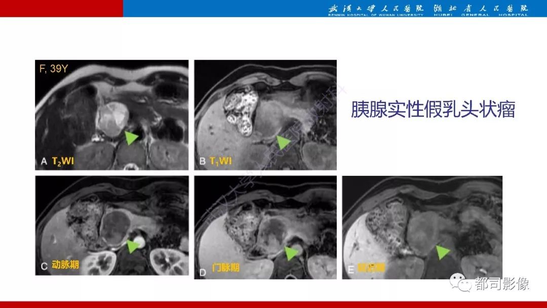 影像PPT - 【PPT】胰腺常见实质性肿瘤临床影像诊断与鉴别-31