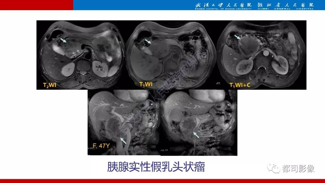 影像PPT - 【PPT】胰腺常见实质性肿瘤临床影像诊断与鉴别-32
