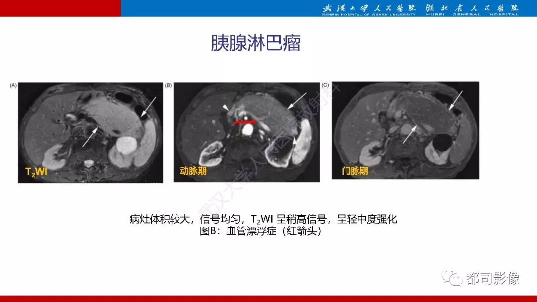 影像PPT - 【PPT】胰腺常见实质性肿瘤临床影像诊断与鉴别-35