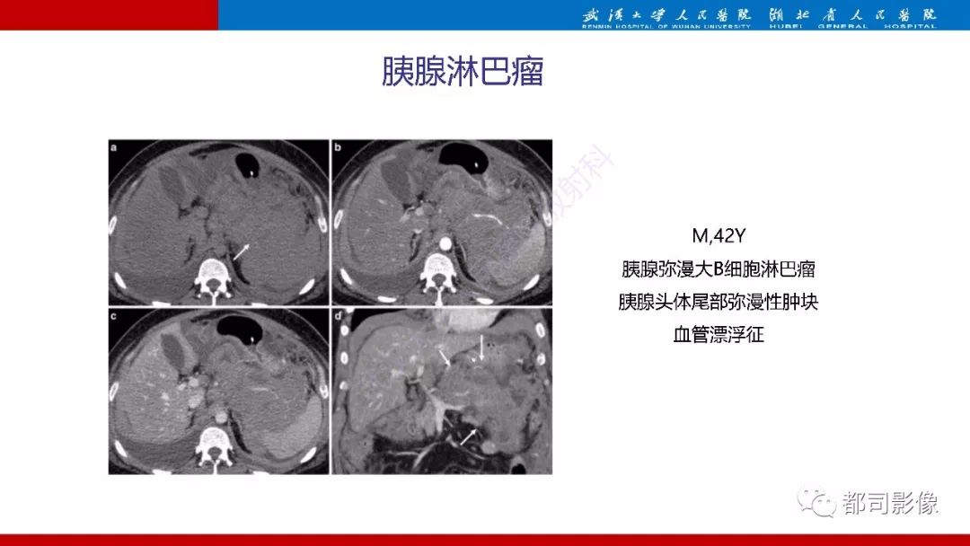 影像PPT - 【PPT】胰腺常见实质性肿瘤临床影像诊断与鉴别-36