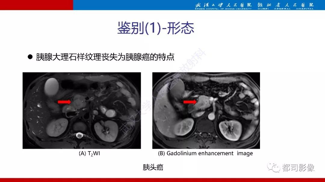 影像PPT - 【PPT】胰腺常见实质性肿瘤临床影像诊断与鉴别-39