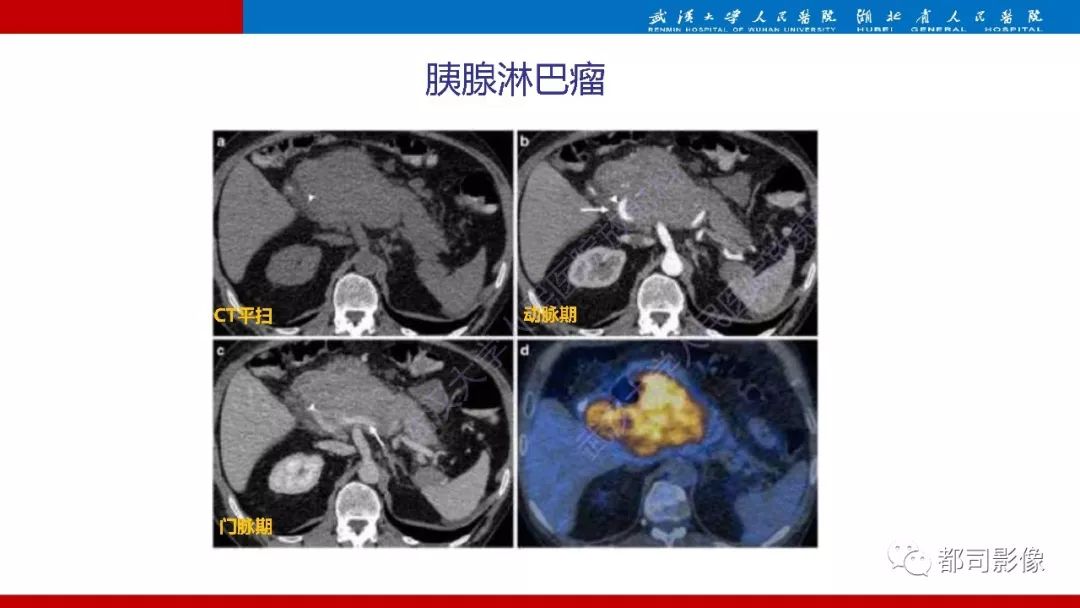 影像PPT - 【PPT】胰腺常见实质性肿瘤临床影像诊断与鉴别-34
