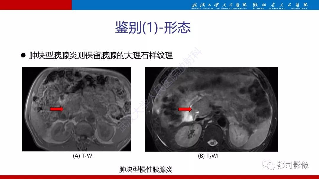 影像PPT - 【PPT】胰腺常见实质性肿瘤临床影像诊断与鉴别-40