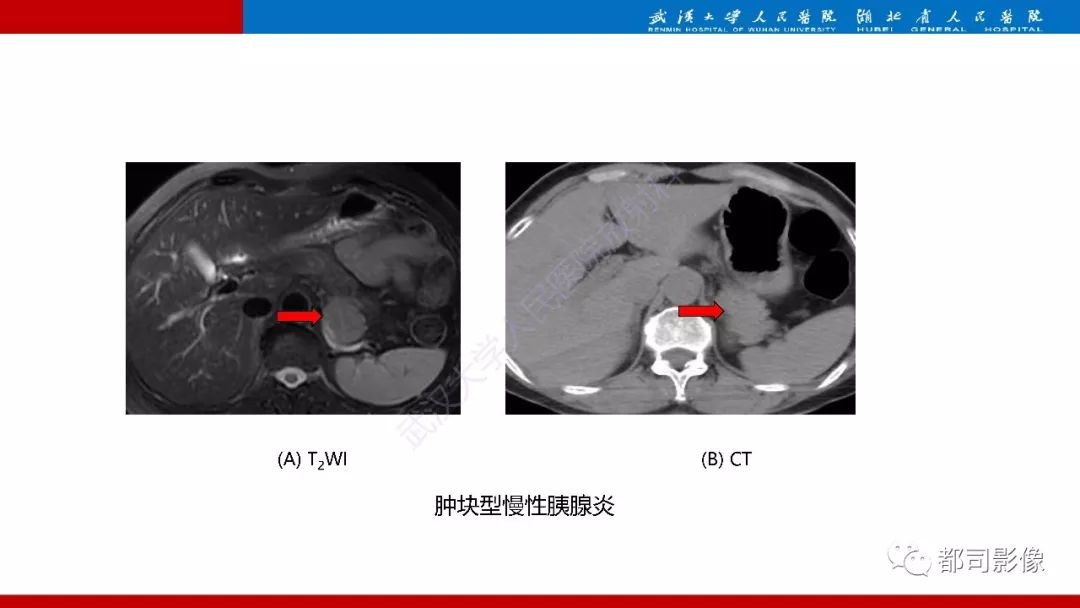影像PPT - 【PPT】胰腺常见实质性肿瘤临床影像诊断与鉴别-41
