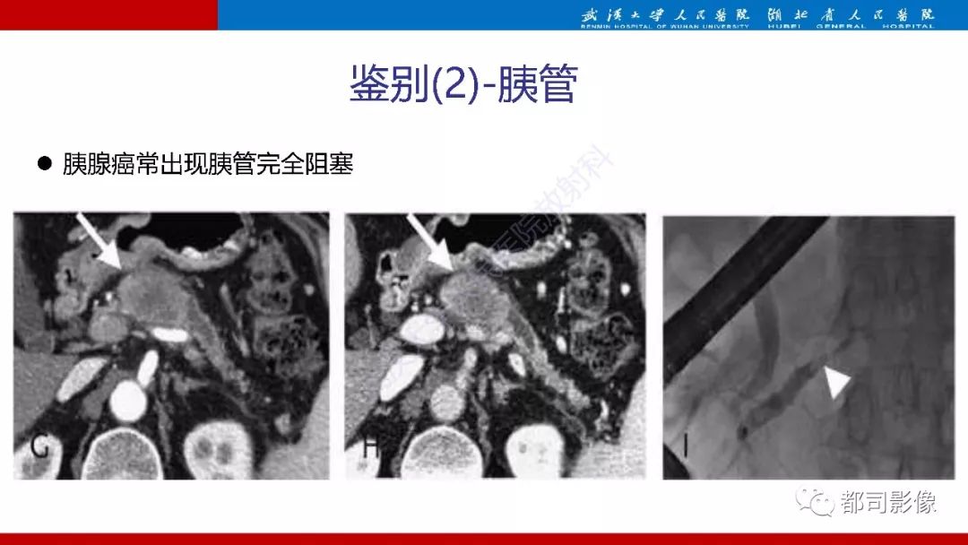 影像PPT - 【PPT】胰腺常见实质性肿瘤临床影像诊断与鉴别-42