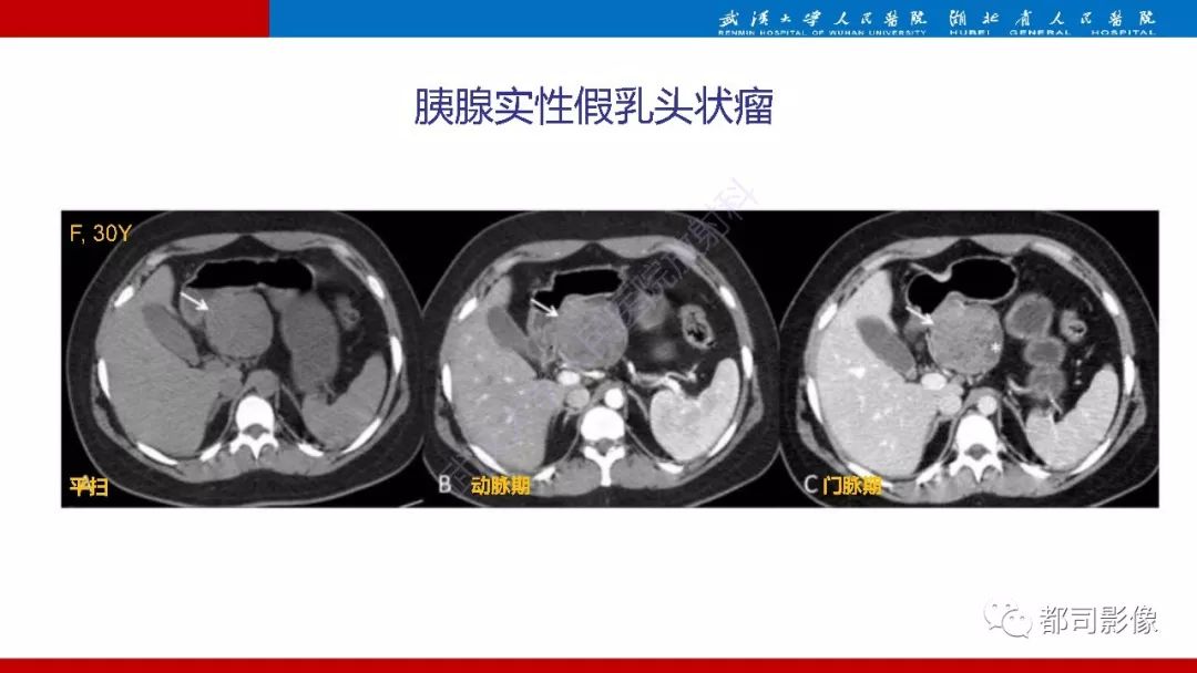 影像PPT - 【PPT】胰腺常见实质性肿瘤临床影像诊断与鉴别-30