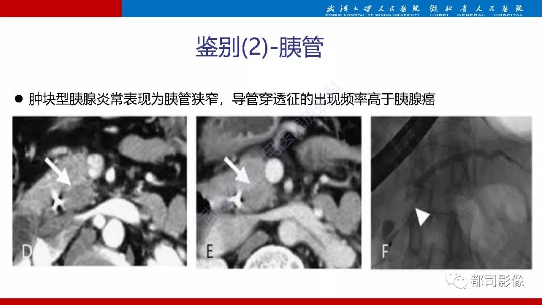影像PPT - 【PPT】胰腺常见实质性肿瘤临床影像诊断与鉴别-43