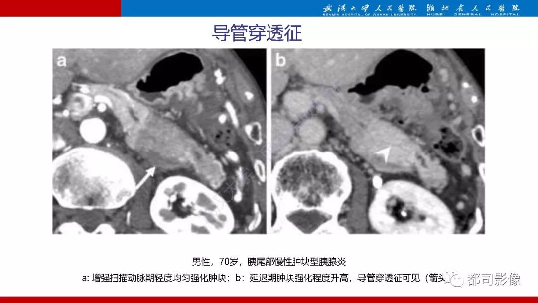 影像PPT - 【PPT】胰腺常见实质性肿瘤临床影像诊断与鉴别-44