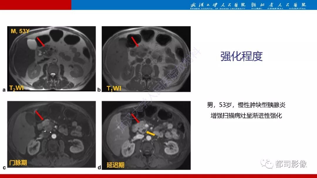 影像PPT - 【PPT】胰腺常见实质性肿瘤临床影像诊断与鉴别-46