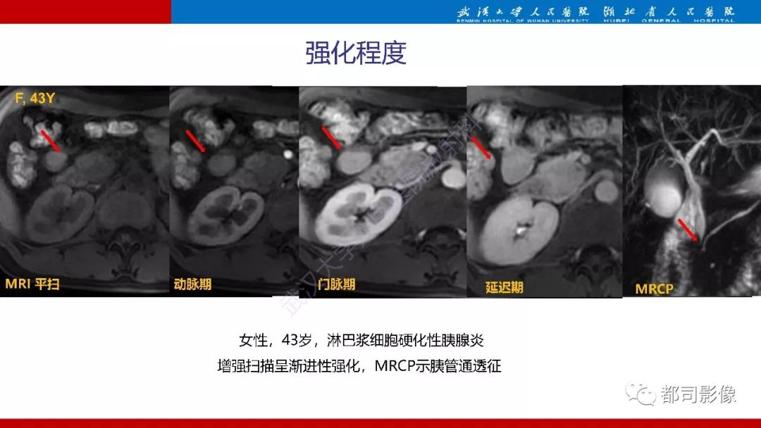 影像PPT - 【PPT】胰腺常见实质性肿瘤临床影像诊断与鉴别-47