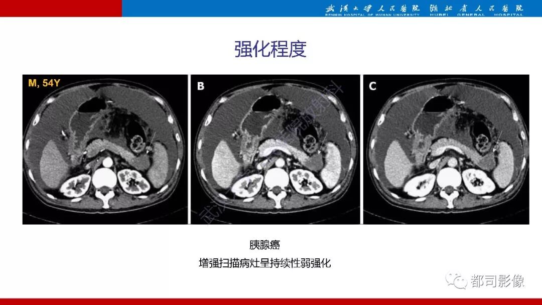 影像PPT - 【PPT】胰腺常见实质性肿瘤临床影像诊断与鉴别-48