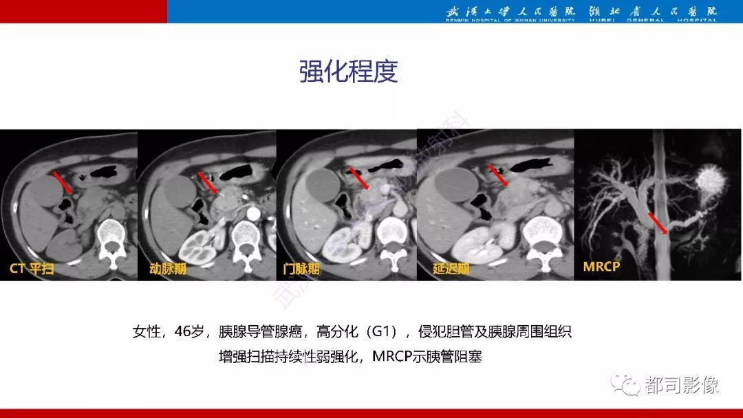 影像PPT - 【PPT】胰腺常见实质性肿瘤临床影像诊断与鉴别-49