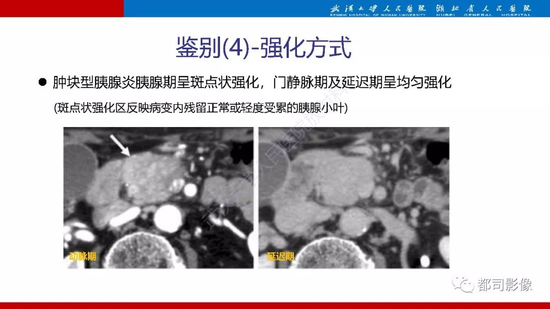 影像PPT - 【PPT】胰腺常见实质性肿瘤临床影像诊断与鉴别-50