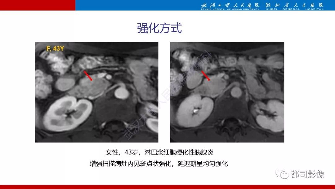 影像PPT - 【PPT】胰腺常见实质性肿瘤临床影像诊断与鉴别-51