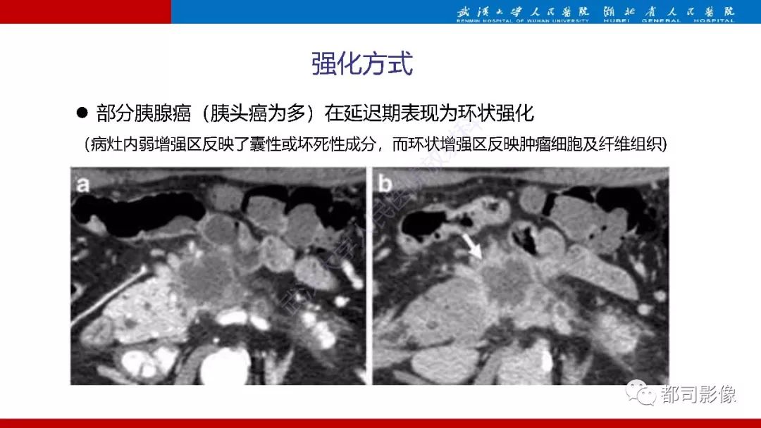 影像PPT - 【PPT】胰腺常见实质性肿瘤临床影像诊断与鉴别-52