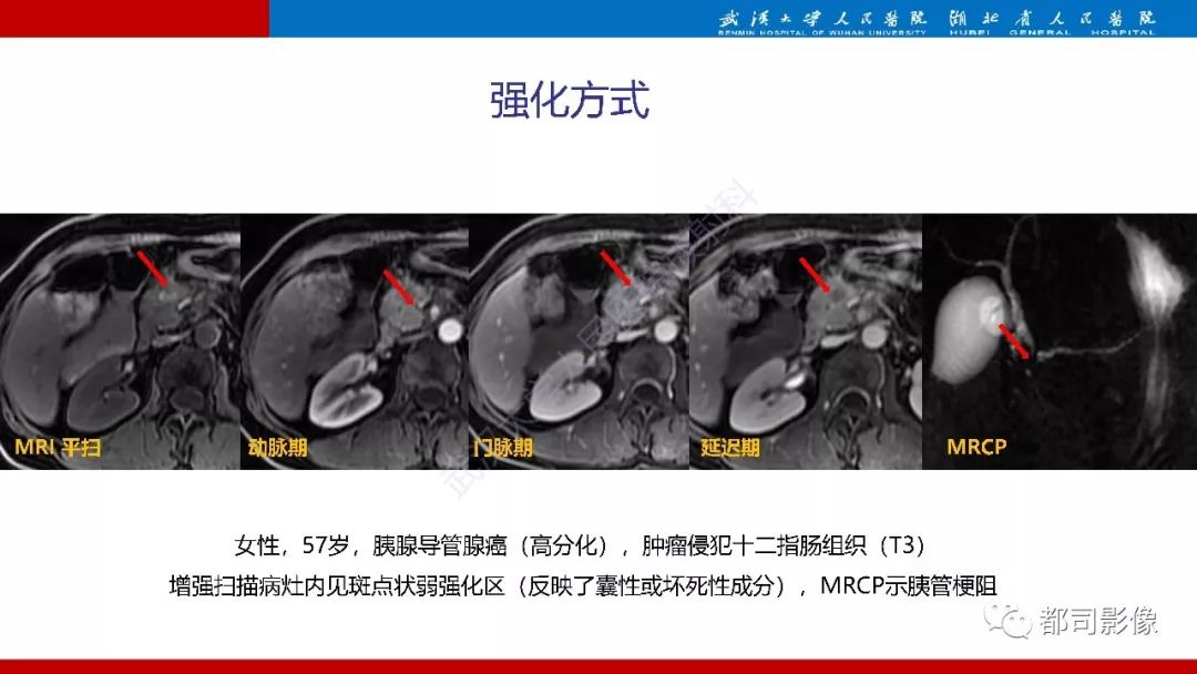 影像PPT - 【PPT】胰腺常见实质性肿瘤临床影像诊断与鉴别-53