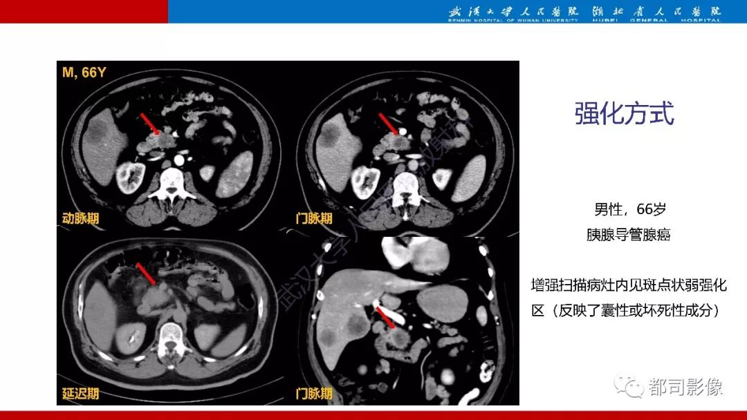 影像PPT - 【PPT】胰腺常见实质性肿瘤临床影像诊断与鉴别-54