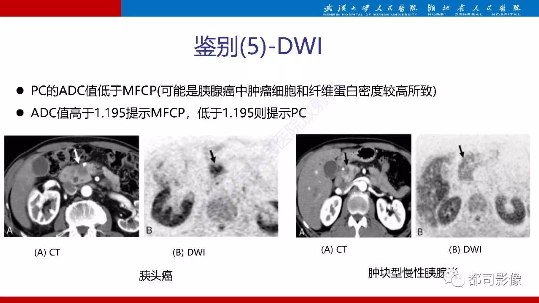 影像PPT - 【PPT】胰腺常见实质性肿瘤临床影像诊断与鉴别-55