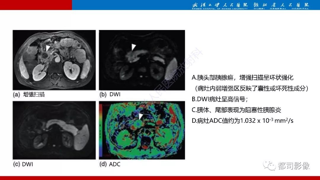 影像PPT - 【PPT】胰腺常见实质性肿瘤临床影像诊断与鉴别-56