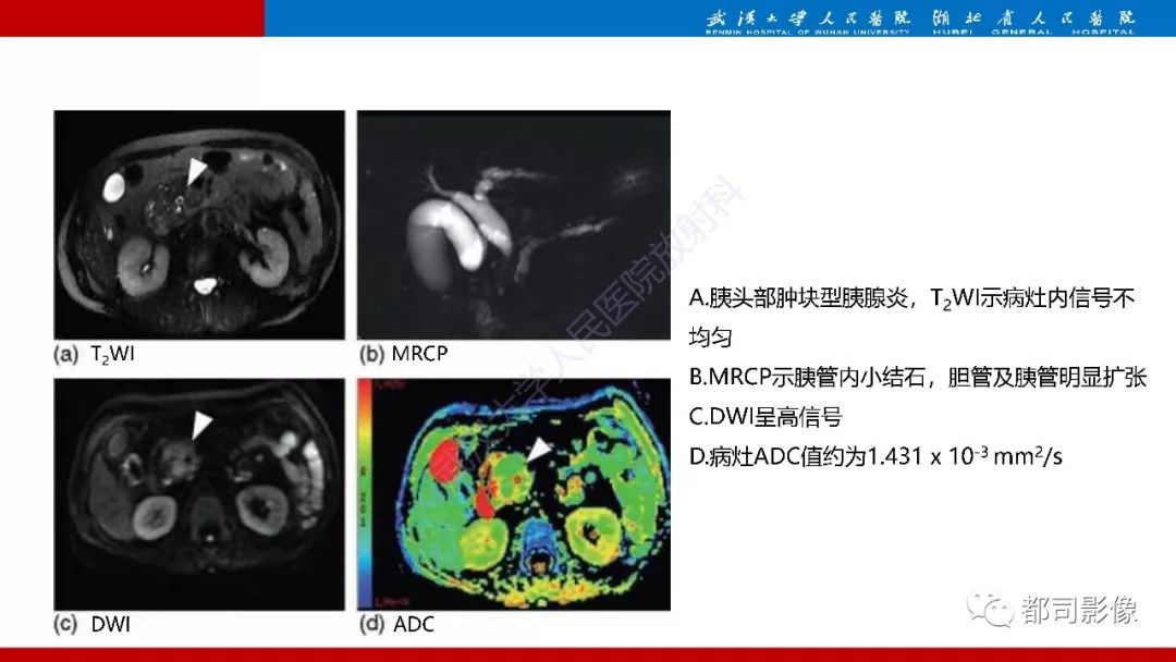 影像PPT - 【PPT】胰腺常见实质性肿瘤临床影像诊断与鉴别-57