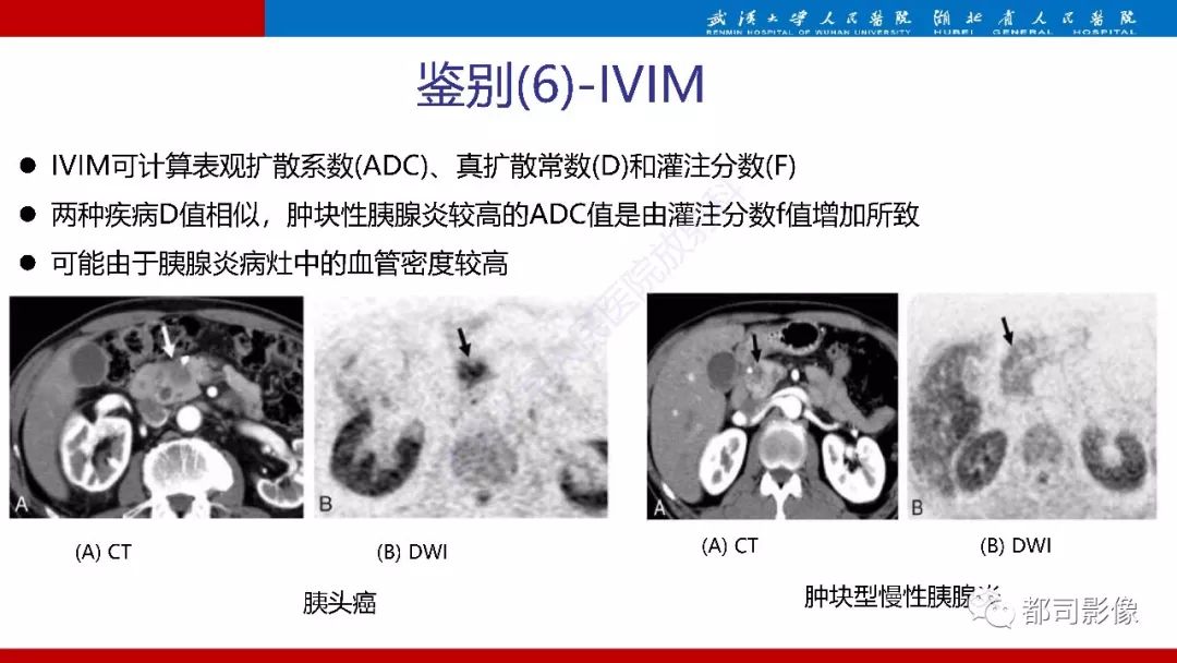 影像PPT - 【PPT】胰腺常见实质性肿瘤临床影像诊断与鉴别-58