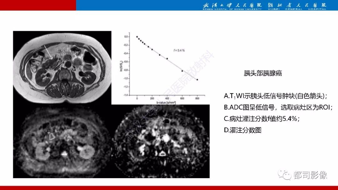 影像PPT - 【PPT】胰腺常见实质性肿瘤临床影像诊断与鉴别-59