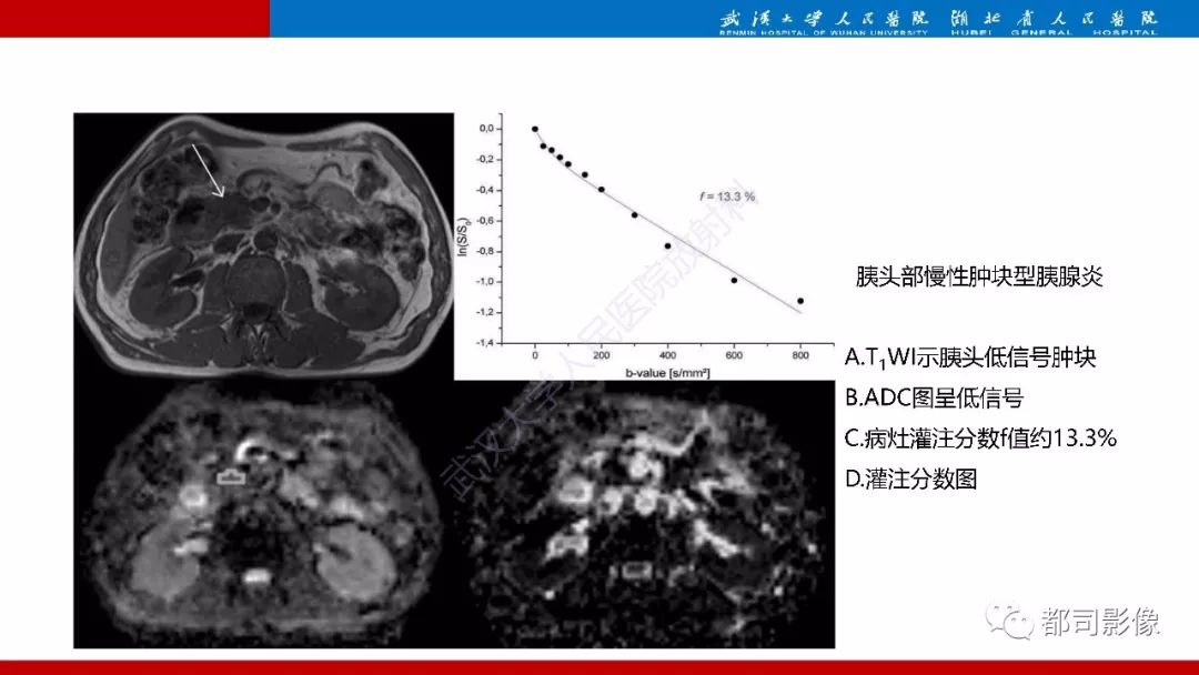 影像PPT - 【PPT】胰腺常见实质性肿瘤临床影像诊断与鉴别-60